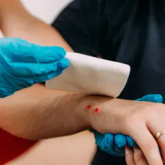 Opatrywanie rany po ukąszeniu żmii na przedramieniu. Dwie czerwone ranki z widocznymi śladami ugryzienia.