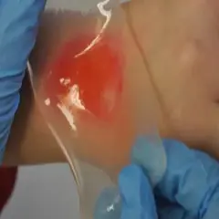 Ręka z oparzeniem, na które przykładany jest przezroczysty plaster żelowy na oparzenia.