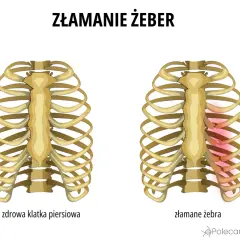 Porównanie zdrowej klatki piersiowej z tą, gdzie występuje złamanie żeber. Po prawej stronie widać uszkodzone żebra, zaznaczone na czerwono.