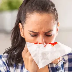 Kobieta z krwawiącym nosem, trzymająca chusteczkę. Dowiedz się, jak zatamować krwotok z nosa.