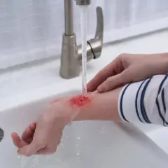 Ręka z oparzeniem parą pod bieżącą wodą. Chłodzenie rany to pierwsze, co należy zrobić, gdy dojdzie do oparzenia parą.