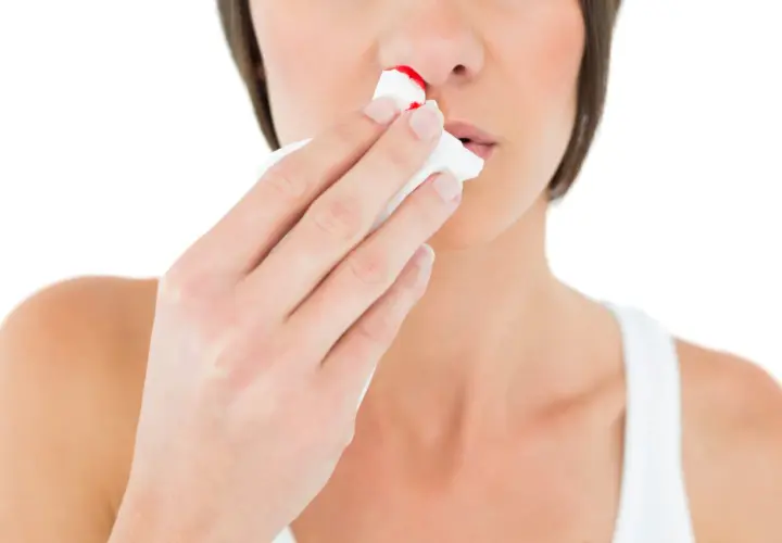 Kobieta z krwotokiem z nosa, który może być spowodowany brakiem witaminy.