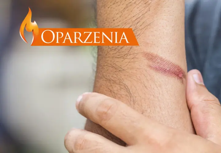 Oparzenia na skórze. Dowiedz się, jak udzielić pierwszej pomocy przy oparzeniach, aby zminimalizować szkody.