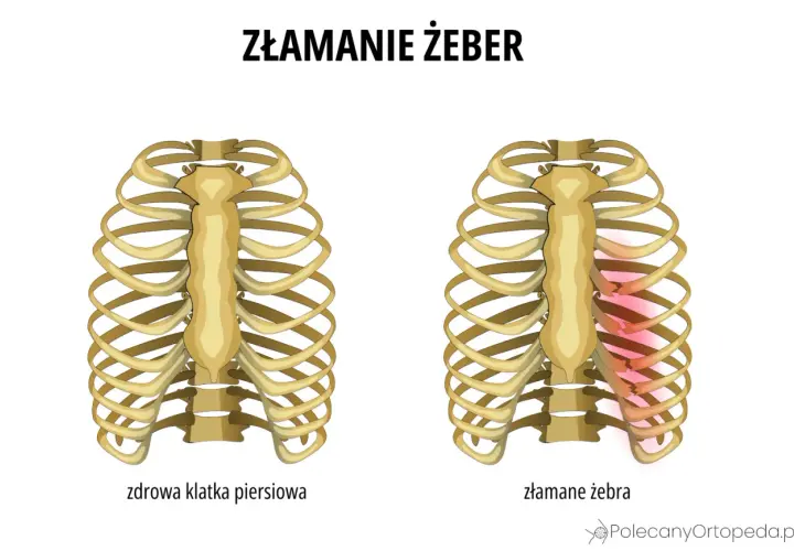 Porównanie zdrowej klatki piersiowej z tą, gdzie występuje złamanie żeber. Po prawej stronie widać uszkodzone żebra, zaznaczone na czerwono.