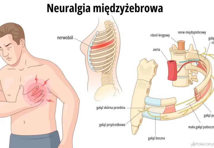 Mężczyzna odczuwa ból mostka, ilustracja pokazuje unerwienie żeber i kręgosłupa, wyjaśniając neuralgię międzyżebrową.