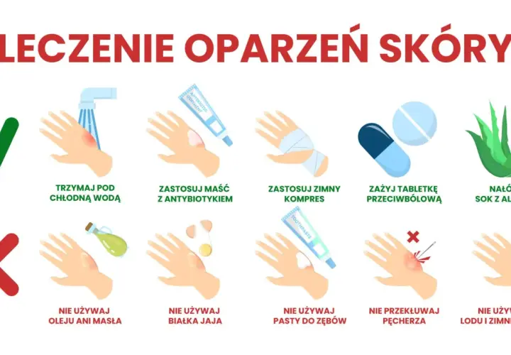 Porady dotyczące leczenia oparzeń skóry: chłodna woda, maść z antybiotykiem, zimny kompres, leki przeciwbólowe, aloes. Unikaj masła, jajka, pasty do zębów, lodu. Nie przekłuwaj pęcherzy.
