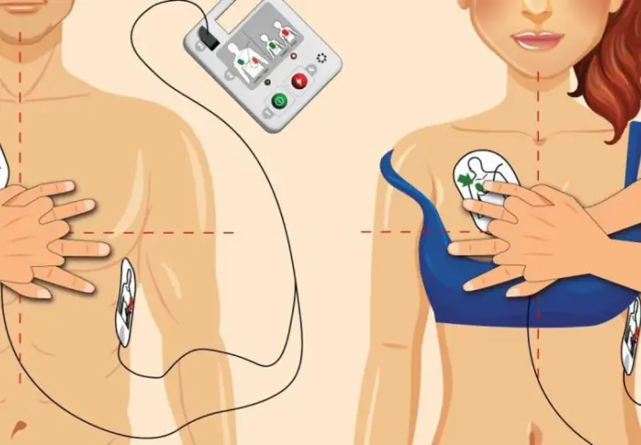 Instrukcja użycia AED: elektrody przyłożone do klatki piersiowej, urządzenie analizuje rytm serca, by wykryć migotanie komór.