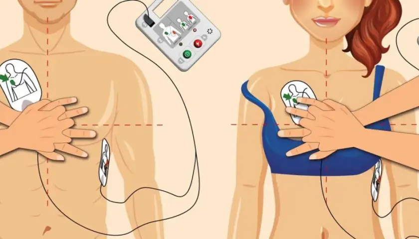 Instrukcja użycia AED: elektrody przyłożone do klatki piersiowej, urządzenie analizuje rytm serca, by wykryć migotanie komór.