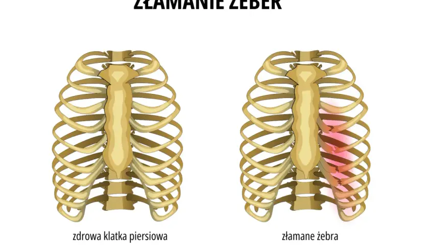 Porównanie zdrowej klatki piersiowej z tą, gdzie widoczne są stłuczone żebra bez siniaka, zaznaczone czerwonym rumieńcem.