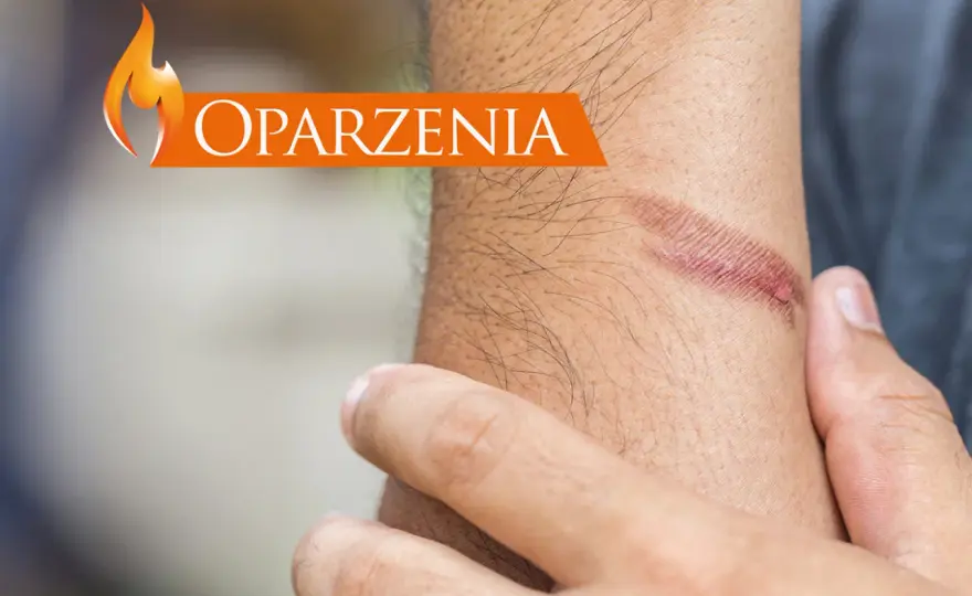 Pierwsza pomoc przy oparzeniach - Co robić, czego unikać?