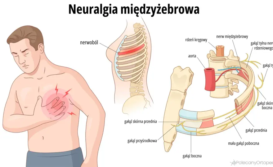 Ból mostka - Kiedy to zawał, a kiedy mięśnie?