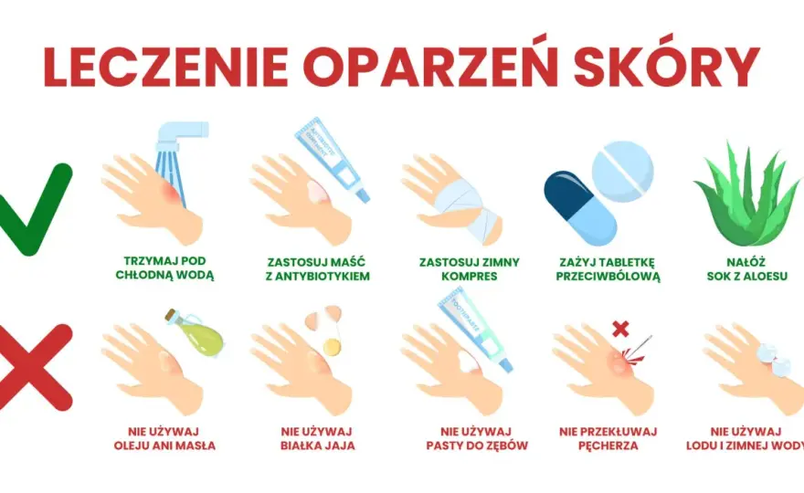Oparzenia - pierwsza pomoc i stopnie. Co robić, czego unikać?