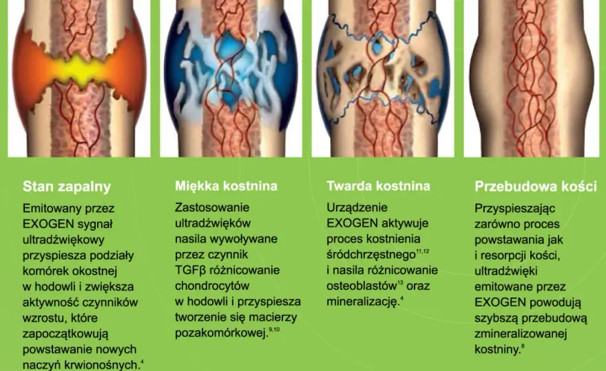 Ile zrasta się kość po złamaniu? Czas, czynniki, pierwsza pomoc
