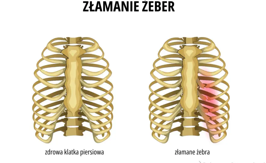 Stłuczone żebra bez siniaka - Co robić? Kiedy do lekarza?