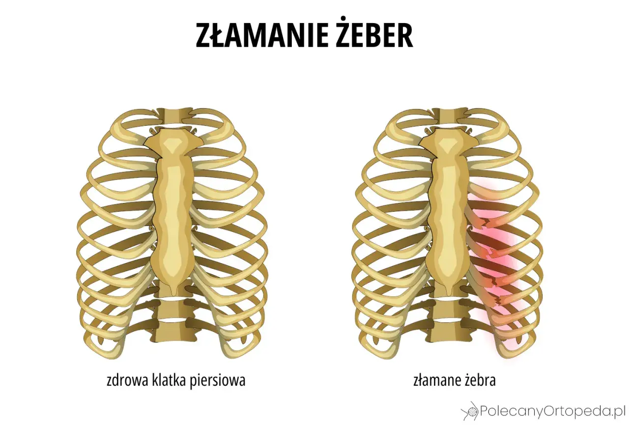 Porównanie zdrowej klatki piersiowej z tą, gdzie występuje złamanie żeber. Po prawej stronie widać uszkodzone żebra, zaznaczone na czerwono.