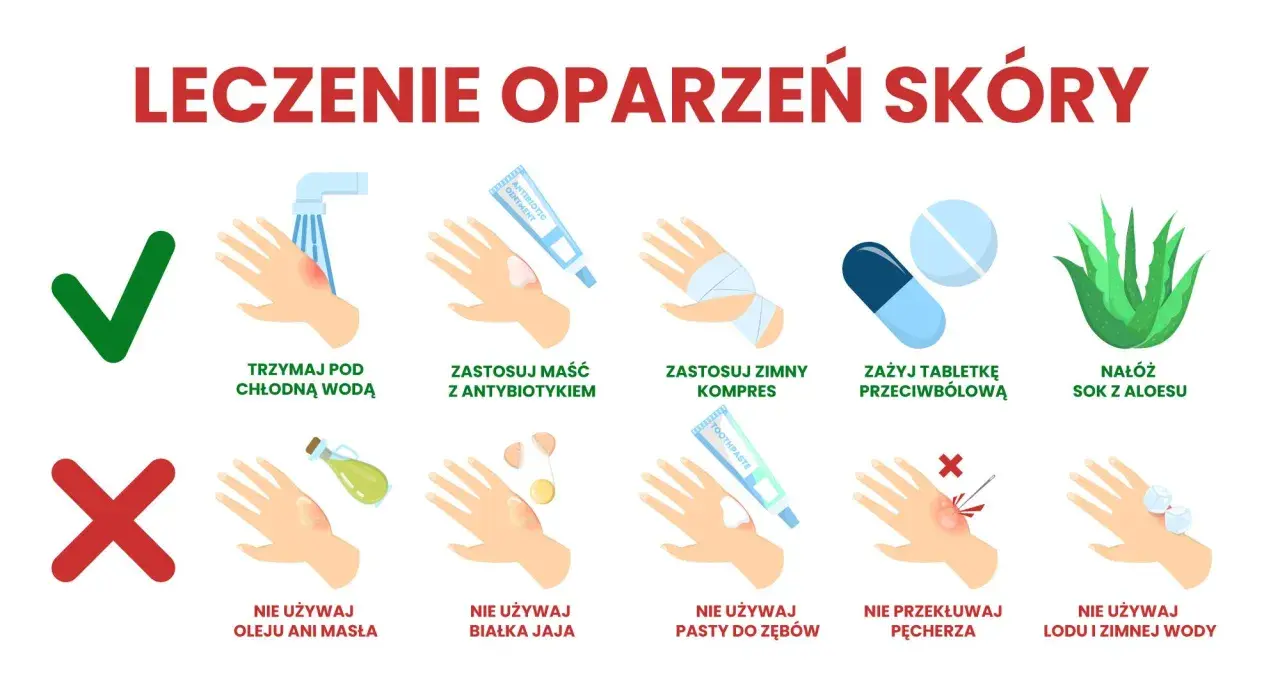 Porady dotyczące leczenia oparzeń skóry: chłodna woda, maść z antybiotykiem, zimny kompres, leki przeciwbólowe, aloes. Unikaj masła, jajka, pasty do zębów, lodu. Nie przekłuwaj pęcherzy.