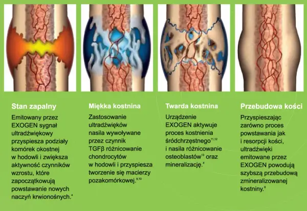 Ilustracja pokazuje etapy zrastania się kości: stan zapalny, miękka kostnina, twarda kostnina i przebudowa kości.